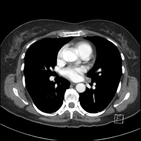 File:Breast metastases from renal cell cancer (Radiopaedia 79220-92225 A 49).jpg