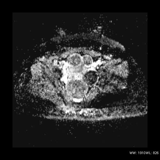 File:Broad ligament fibroid (Radiopaedia 49135-54241 Axial ADC 17).jpg