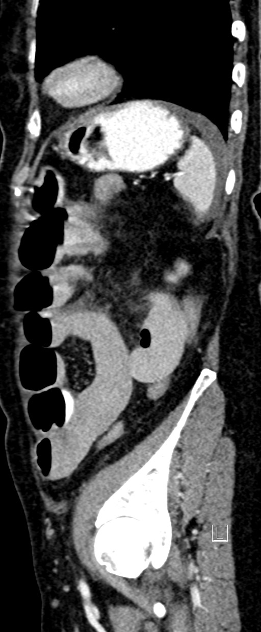 Broad ligament hernia (Radiopaedia 84802-100276 C 13).jpg