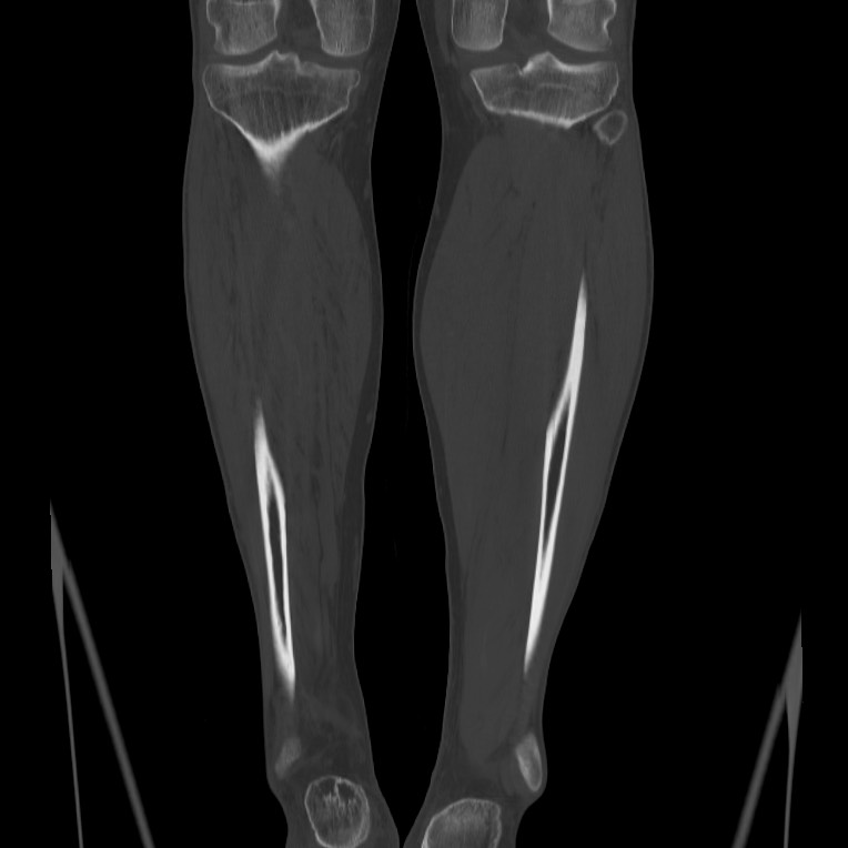 Brodie abscess - tibia (Radiopaedia 66028-75204 Coronal bone window 54).jpg