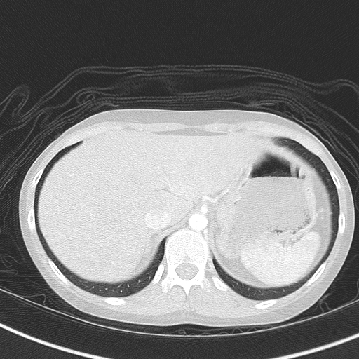 File:Bronchial atresia (Radiopaedia 73677-84470 Axial lung window 54).jpg