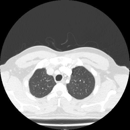 File:Bronchial carcinoid (Radiopaedia 80013-93291 Axial lung window 8).jpg