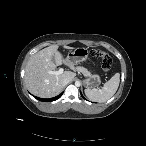 Bronchial carcinoid tumor (Radiopaedia 78272-90875 A 94).jpg