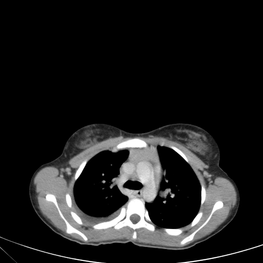 Bronchial mucoepidermoid carcinoma (Radiopaedia 57023-63895 Axial 34).jpg