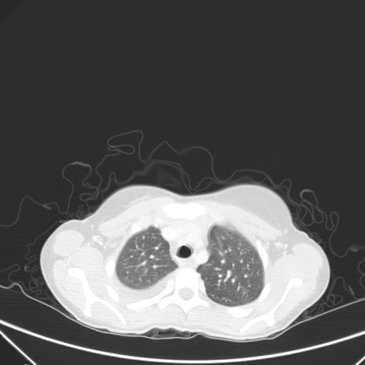 Bronchial mucoepidermoid carcinoma (Radiopaedia 57023-63895 Axial lung window 22).jpg