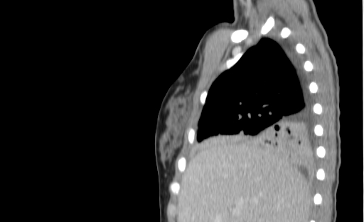Bronchial mucoepidermoid carcinoma (Radiopaedia 57023-63895 Sagittal 40).jpg