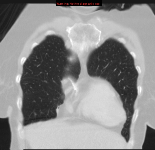Bronchoalveolar carcinoma (BAC) (Radiopaedia 13436-13392 Coronal lung window 12).jpg
