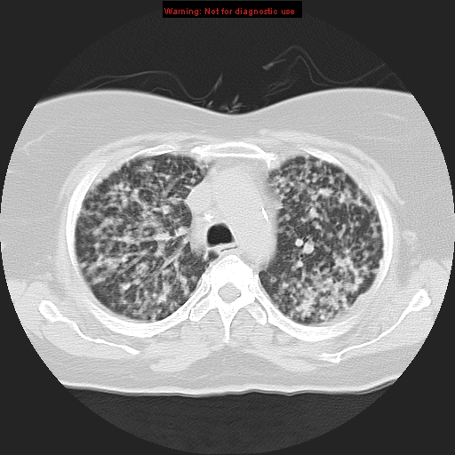 File:Bronchoalveolar carcinoma (Radiopaedia 13224-13233 Axial lung window 15).jpg