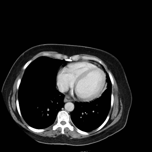 Bronchogenic carcinoma (Radiopaedia 73497-84262 A 45).jpg