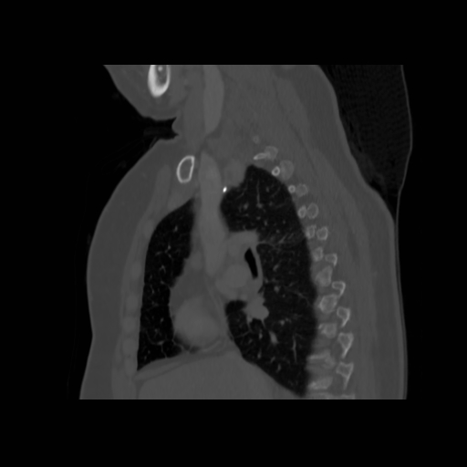 Bronchogenic carcinoma (Radiopaedia 73497-84262 Sagittal bone window 70).jpg