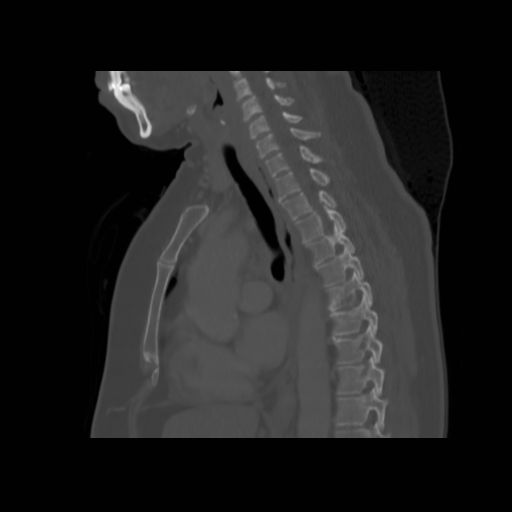 File:Bronchogenic carcinoma (Radiopaedia 73497-84262 Sagittal bone window 84).jpg