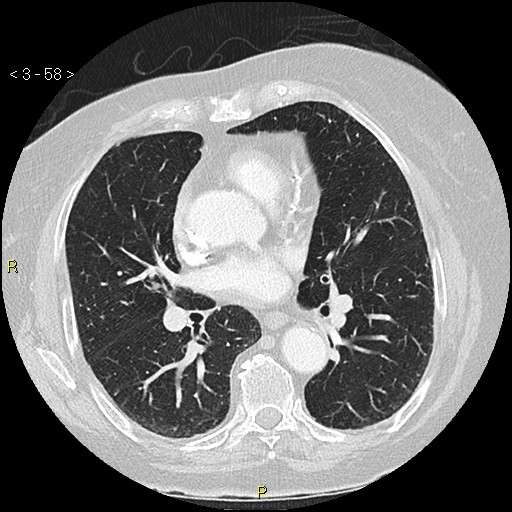 File:Bronchogenic carcinoma as an incidental finding (Radiopaedia 16453-16130 Axial lung window 58).jpg