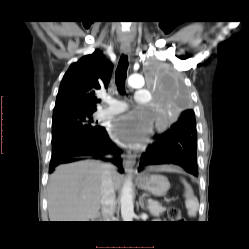 File:Bronchogenic carcinoma with left atrial large deposit - T4N3M1a (Radiopaedia 42316-45428 B 9).jpg