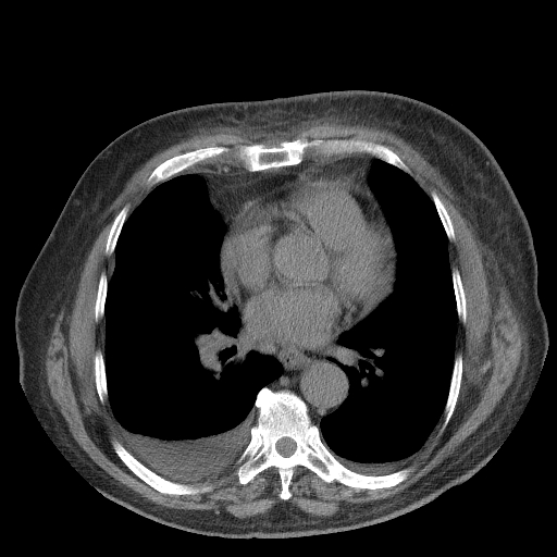 File:Bronchogenic carcinoma with metastatic lymphadenopathy (Radiopaedia 37671-39569 Axial non-contrast 33).jpg
