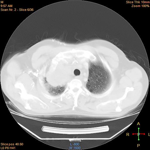 File:Bronchogenic carcinoma with superior vena caval invasion (Radiopaedia 22378-22406 lung window 3).jpg