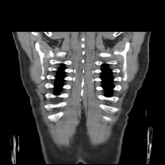 Bronchogenic carcinoma with upper lobe collapse (Radiopaedia 29297-29726 D 51).jpg