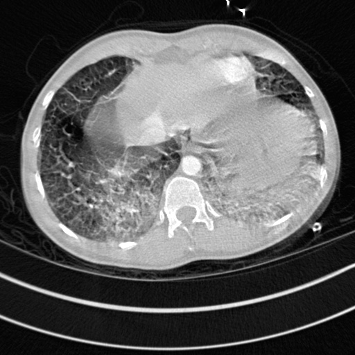 Bronchogenic cyst (Radiopaedia 77801-90071 Axial lung window 74).jpg