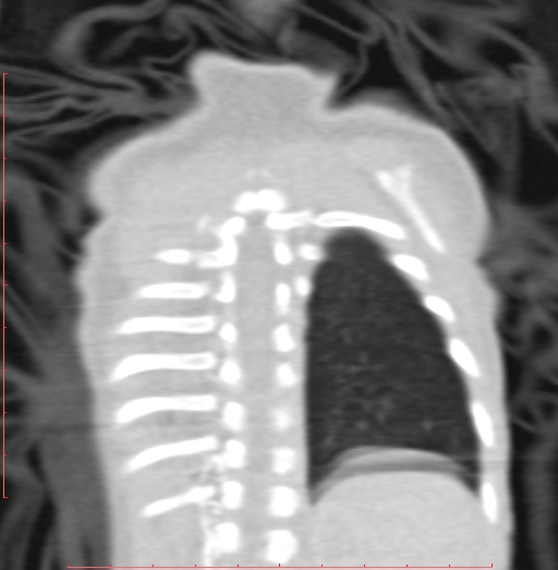 Bronchogenic cyst (Radiopaedia 78599-91409 Coronal lung window 191).jpg