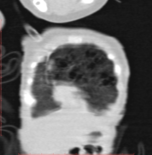 Bronchogenic cyst (Radiopaedia 78599-91409 Coronal lung window 31).jpg