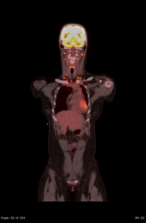 Brown fat uptake (FDG PET-CT) (Radiopaedia 77392-89513 Fused coronal 40).jpg