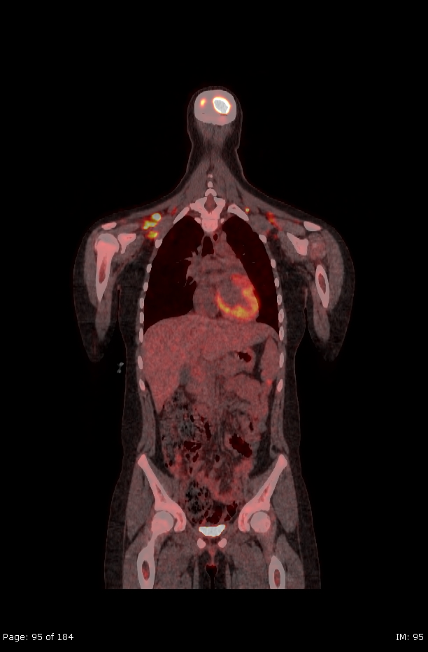 Brown fat uptake (FDG PET-CT) (Radiopaedia 77392-89513 Fused coronal 53).jpg