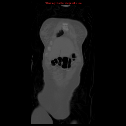 File:Brown tumor (Radiopaedia 12318-12596 D 13).jpg