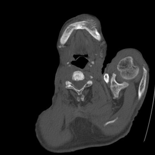 File:Brown tumor with secondary hyperparathyroidism (Radiopaedia 23591-23705 C 2).jpg
