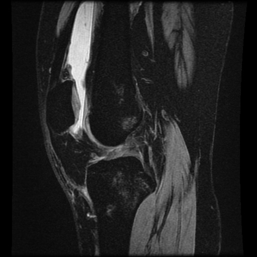 Bucket handle meniscus tear (Radiopaedia 56916-63751 H 44).jpg