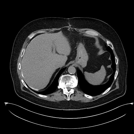 File:Buried bumper syndrome - gastrostomy tube (Radiopaedia 63843-72577 Axial Inject 19).jpg