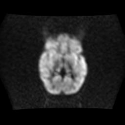 File:Burkitt lymphoma of the orbit- pre and post chemotherapy (Radiopaedia 31214-31930 Axial DWI 9).jpg