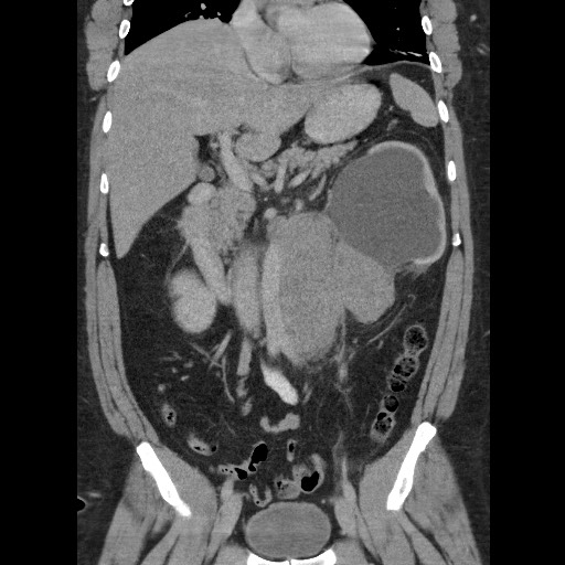File:Burned-out testicular seminoma - retroperitoneal nodal metastases (Radiopaedia 62872-71245 B 32).jpg