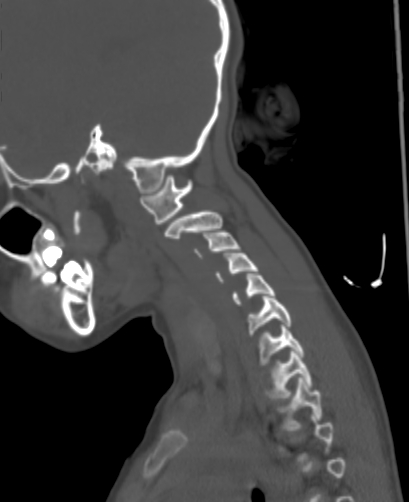 Butterfly vertebra (Radiopaedia 77903-90209 Sagittal bone window 81).jpg