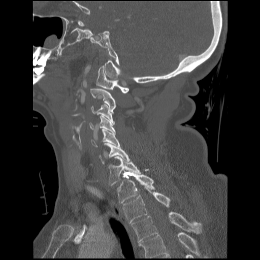File:C1 anterior arch (plough) fracture - type 1 (Radiopaedia 76181-87720 Sagittal bone window 46).jpg