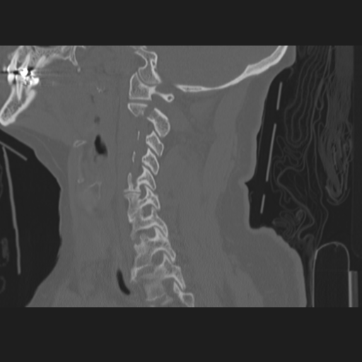 File:C2 fracture (Radiopaedia 34091-35341 Sagittal bone window 28).png