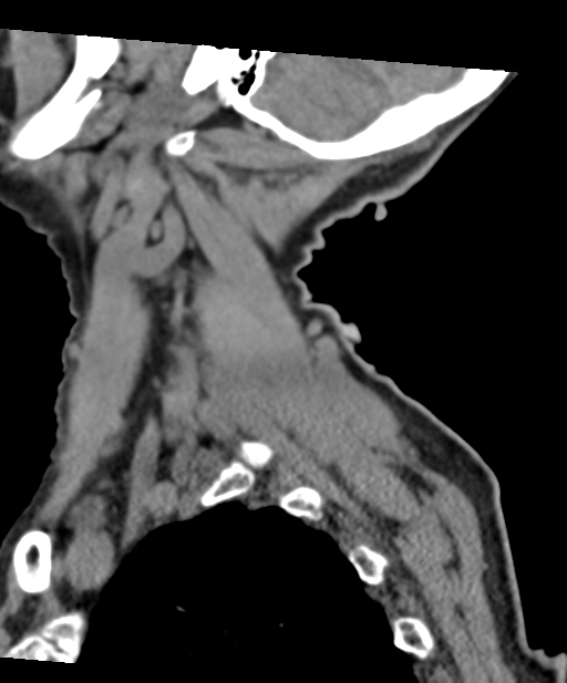 C2 fracture with vertebral artery dissection (Radiopaedia 37378-39199 D 14).png