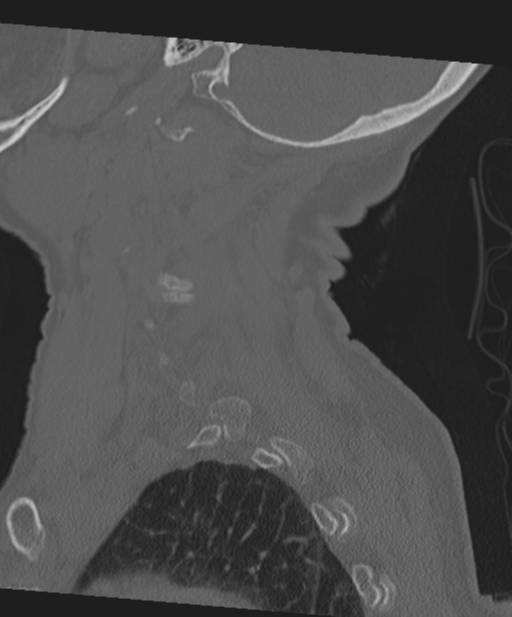 C2 fracture with vertebral artery dissection (Radiopaedia 37378-39199 Sagittal bone window 19).png
