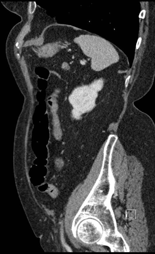 Calcified adrenal glands and Spigelian hernia (Radiopaedia 49741-54988 C 36).jpg