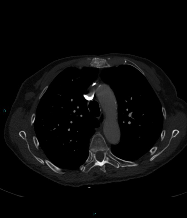 Calcified cerebral emboli from left ventricular thrombus (Radiopaedia 84420-99760 Axial bone window 25).jpg