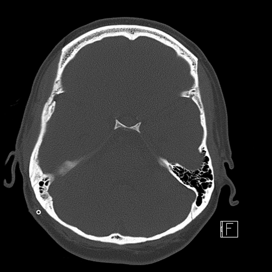 Calcified chronic subdural hematoma (Radiopaedia 77374-89492 Axial bone window 40).jpg