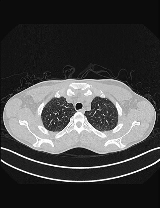 Calcifying pulmonary metastases (Radiopaedia 33359-34396 Axial lung window 12).jpg