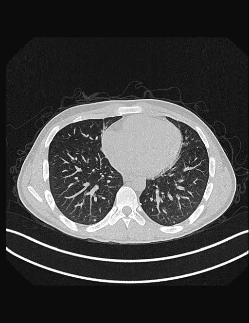 Calcifying pulmonary metastases (Radiopaedia 33359-34396 Axial lung window 42).jpg