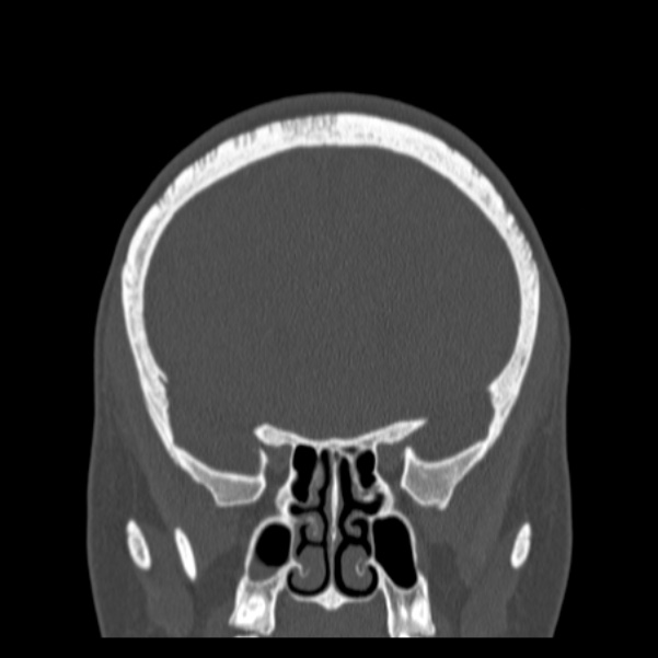 Calvarial osteoma (Radiopaedia 36520-38079 C 31).jpg