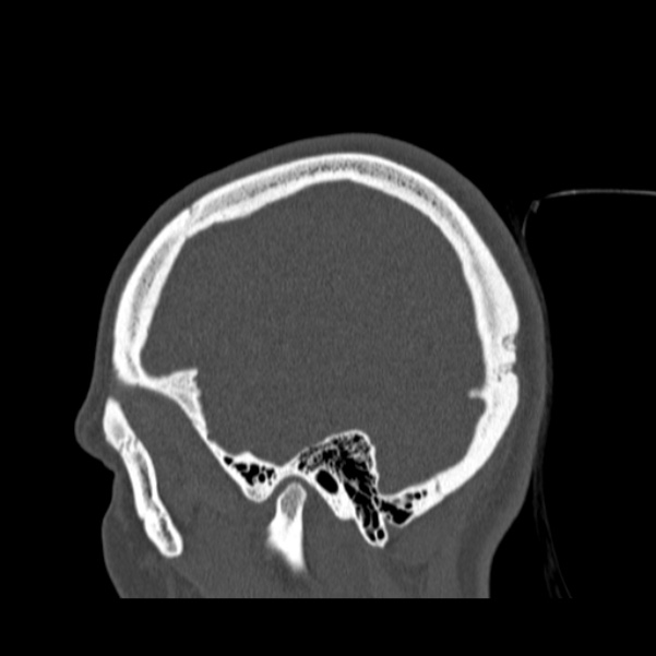 Calvarial osteoma (Radiopaedia 36520-38079 Sagittal bone window 22).jpg
