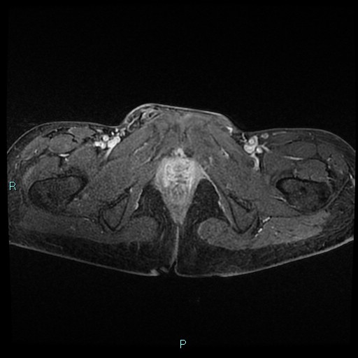 File:Canal of Nuck cyst (Radiopaedia 55074-61448 Axial T1 C+ fat sat 51).jpg