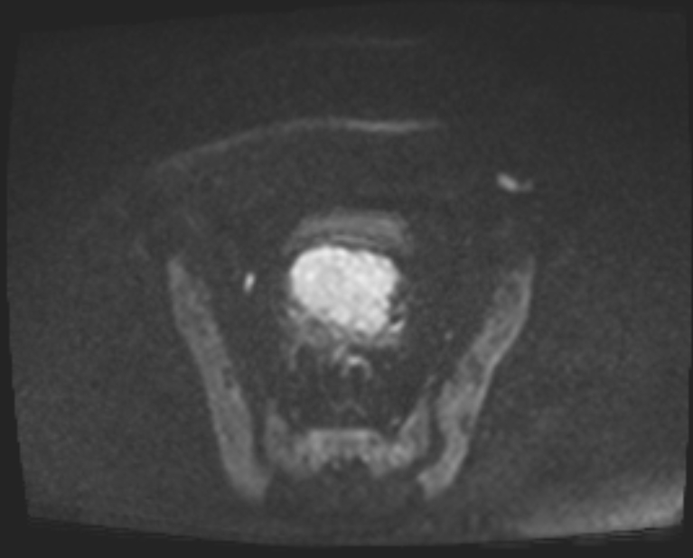 Cancer cervix - stage IIb (Radiopaedia 75411-86615 Axial DWI 76).jpg