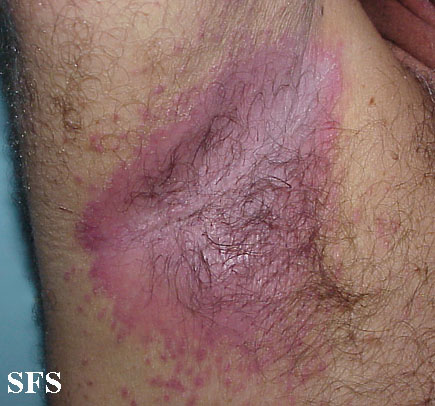 File:Candidiasis (Dermatology Atlas 9).jpg