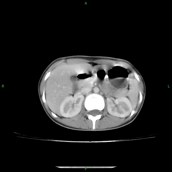 File:Cannon ball metastases - synovial sarcoma (Radiopaedia 26135-26271 C 41).jpg