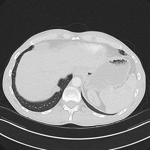 Cannonball metastases - testicular choriocarcinoma (Radiopaedia 84510-99891 Axial lung window 83).jpg