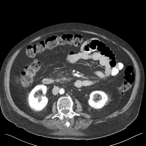 Cannonball metastases from endometrial cancer (Radiopaedia 42003-45031 E 36).png