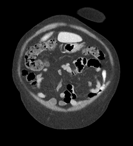 Cannonball metastases from endometrial cancer (Radiopaedia 42003-45031 F 14).png